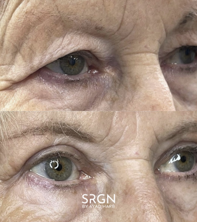 hooded eyes results